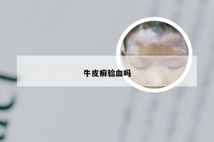 牛皮癣验血吗