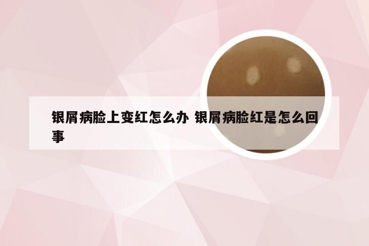 银屑病脸上变红怎么办 银屑病脸红是怎么回事