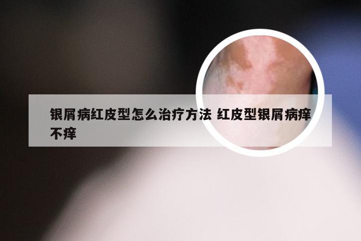 银屑病红皮型怎么治疗方法 红皮型银屑病痒不痒
