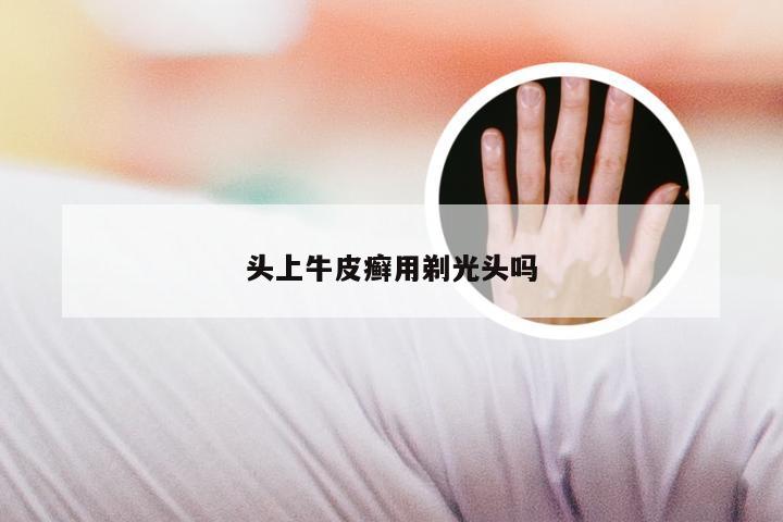 头上牛皮癣用剃光头吗