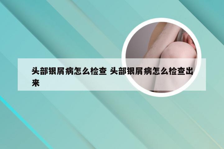 头部银屑病怎么检查 头部银屑病怎么检查出来