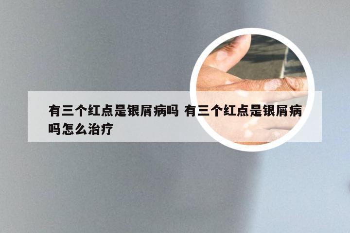 有三个红点是银屑病吗 有三个红点是银屑病吗怎么治疗