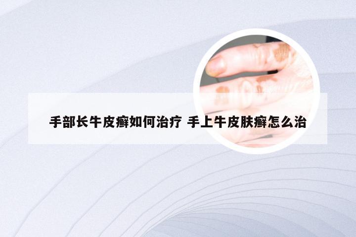 手部长牛皮癣如何治疗 手上牛皮肤癣怎么治
