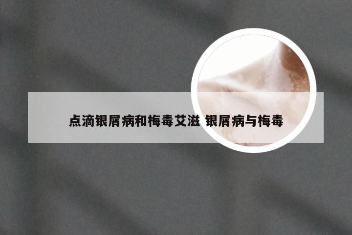 点滴银屑病和梅毒艾滋 银屑病与梅毒