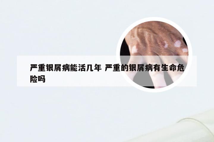 严重银屑病能活几年 严重的银屑病有生命危险吗