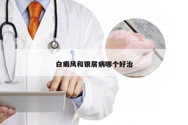 白癜风和银屑病哪个好治