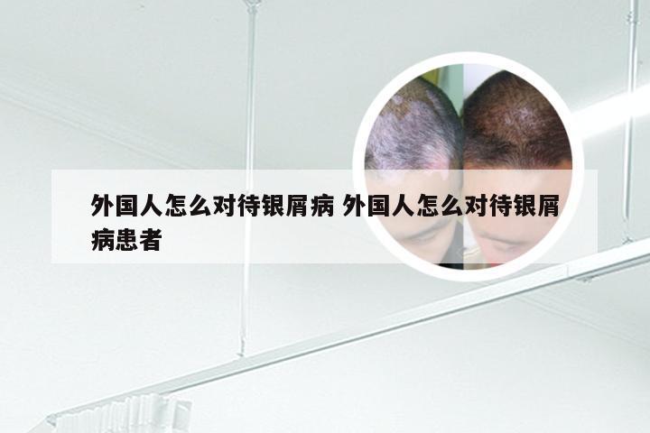 外国人怎么对待银屑病 外国人怎么对待银屑病患者