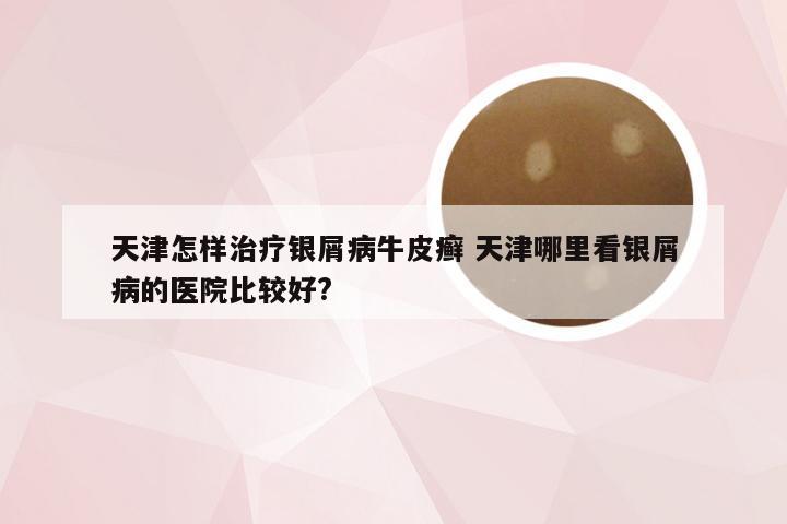 天津怎样治疗银屑病牛皮癣 天津哪里看银屑病的医院比较好?
