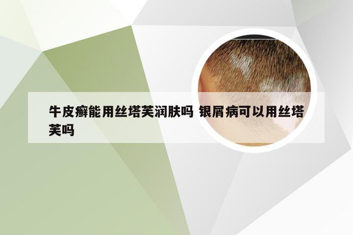 牛皮癣能用丝塔芙润肤吗 银屑病可以用丝塔芙吗