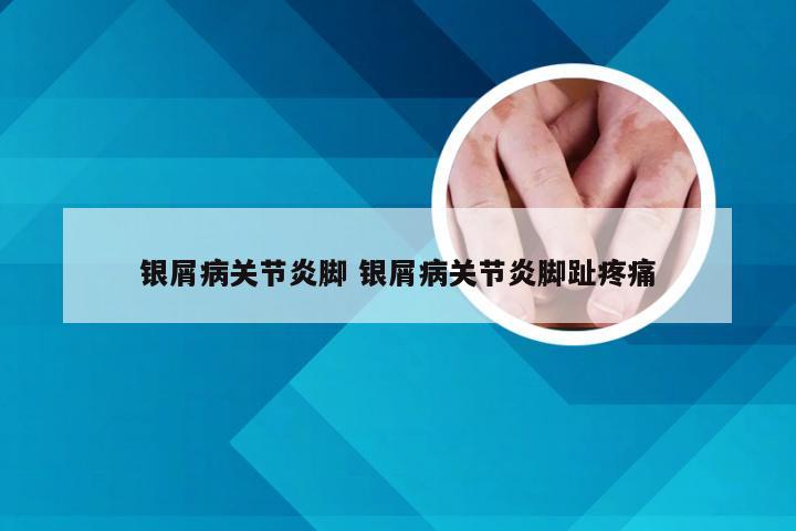 银屑病关节炎脚 银屑病关节炎脚趾疼痛