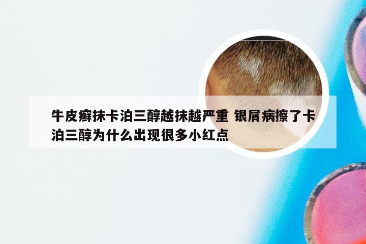 牛皮癣抹卡泊三醇越抹越严重 银屑病擦了卡泊三醇为什么出现很多小红点