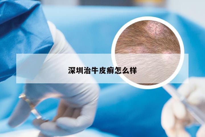 深圳治牛皮癣怎么样