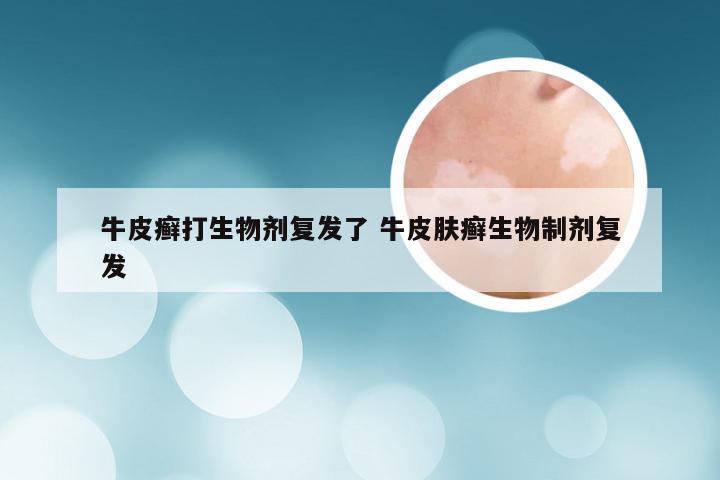 牛皮癣打生物剂复发了 牛皮肤癣生物制剂复发