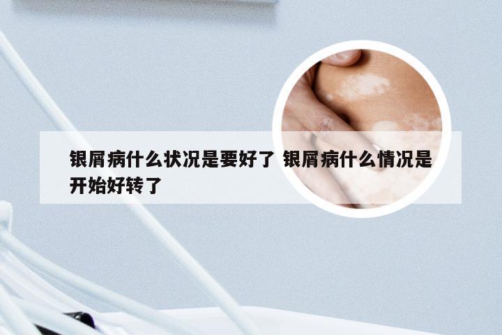 银屑病什么状况是要好了 银屑病什么情况是开始好转了
