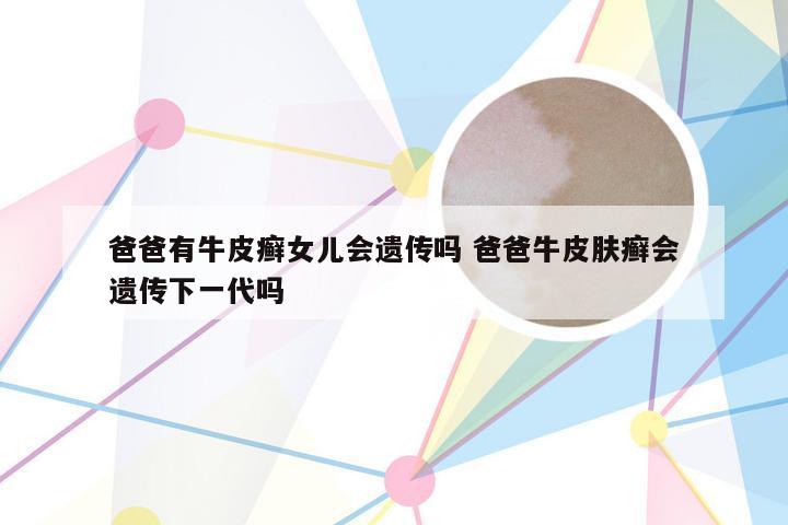 爸爸有牛皮癣女儿会遗传吗 爸爸牛皮肤癣会遗传下一代吗