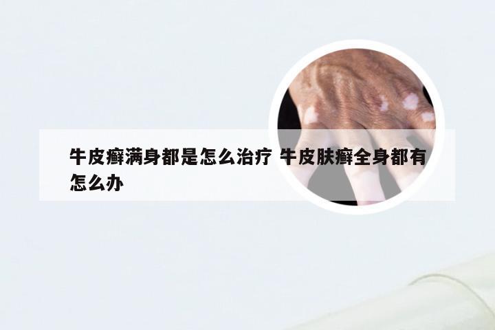 牛皮癣满身都是怎么治疗 牛皮肤癣全身都有怎么办