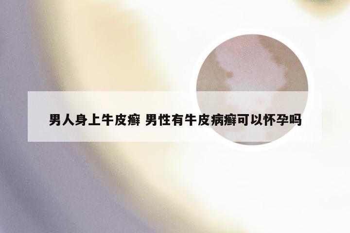 男人身上牛皮癣 男性有牛皮病癣可以怀孕吗