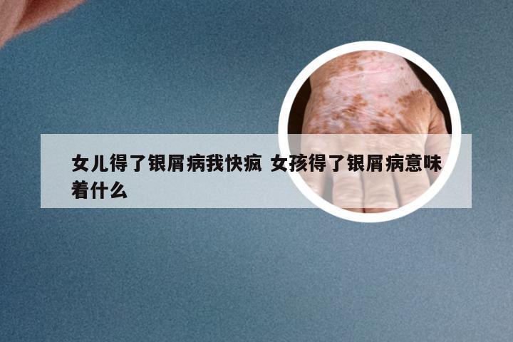 女儿得了银屑病我快疯 女孩得了银屑病意味着什么