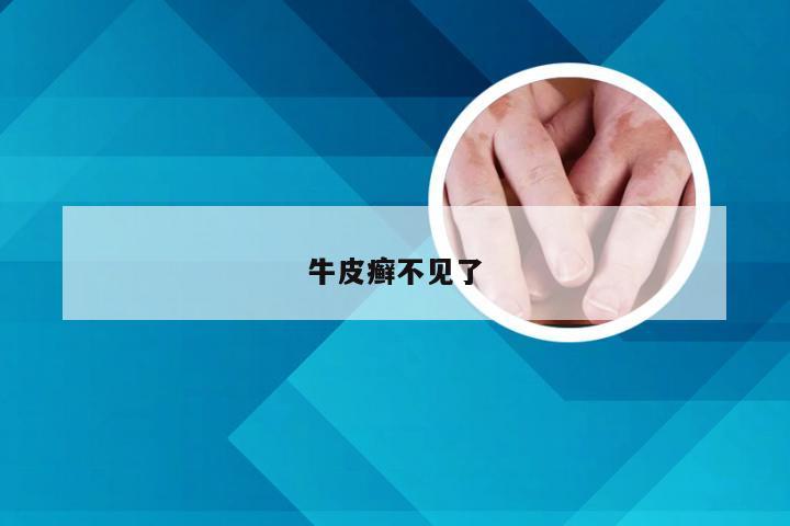 牛皮癣不见了