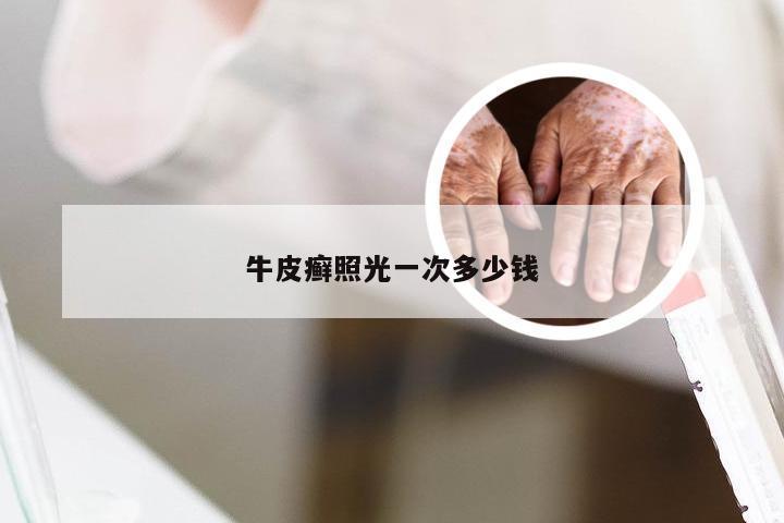 牛皮癣照光一次多少钱