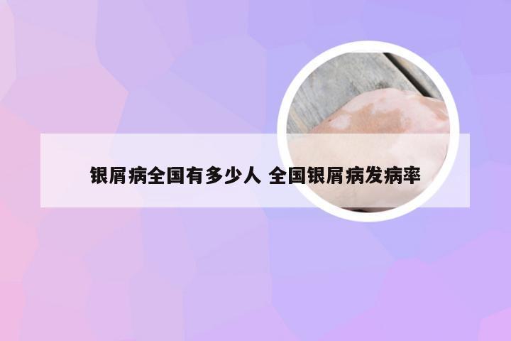 银屑病全国有多少人 全国银屑病发病率