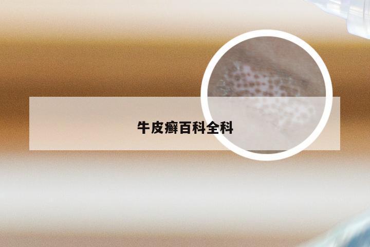 牛皮癣百科全科