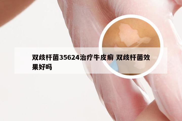 双歧杆菌35624治疗牛皮癣 双歧杆菌效果好吗