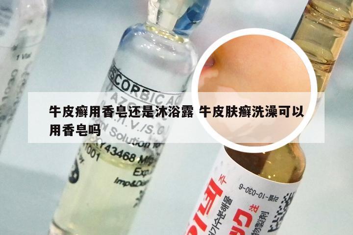 牛皮癣用香皂还是沐浴露 牛皮肤癣洗澡可以用香皂吗