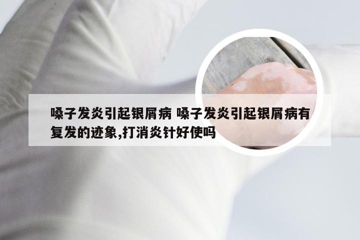 嗓子发炎引起银屑病 嗓子发炎引起银屑病有复发的迹象,打消炎针好使吗