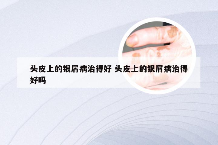 头皮上的银屑病治得好 头皮上的银屑病治得好吗