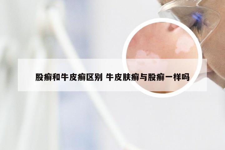 股癣和牛皮癣区别 牛皮肤癣与股癣一样吗