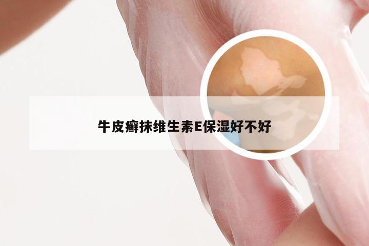 牛皮癣抹维生素E保湿好不好