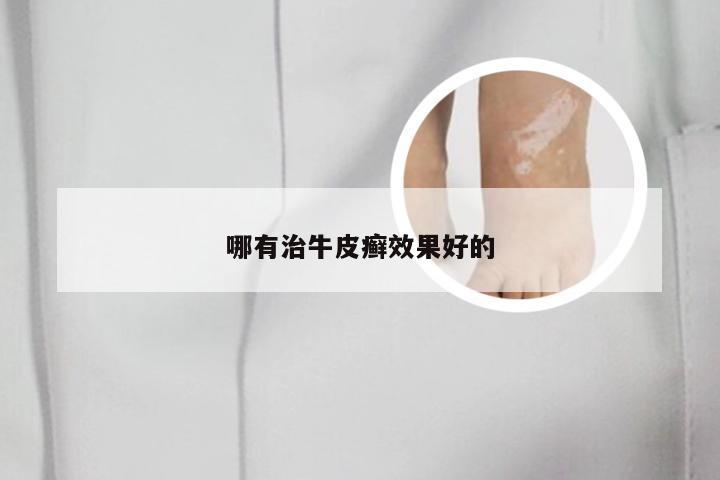 哪有治牛皮癣效果好的