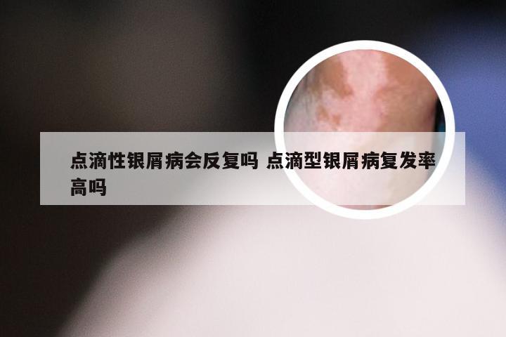 点滴性银屑病会反复吗 点滴型银屑病复发率高吗
