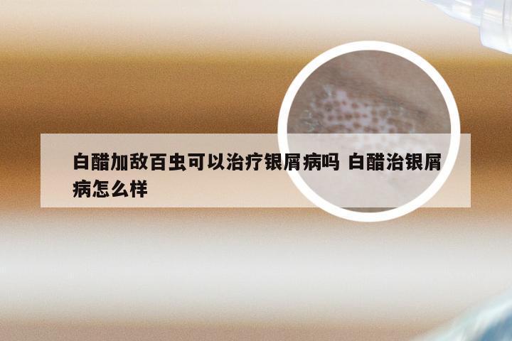 白醋加敌百虫可以治疗银屑病吗 白醋治银屑病怎么样