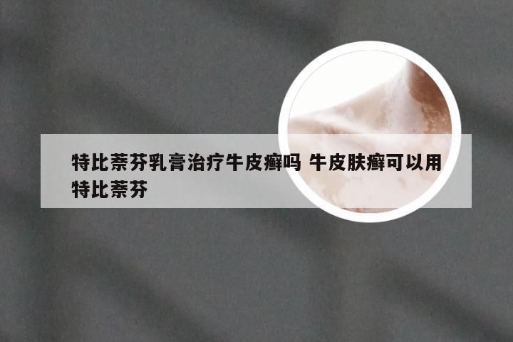 特比萘芬乳膏治疗牛皮癣吗 牛皮肤癣可以用特比萘芬