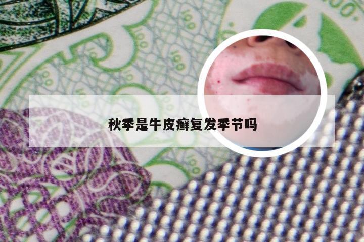秋季是牛皮癣复发季节吗