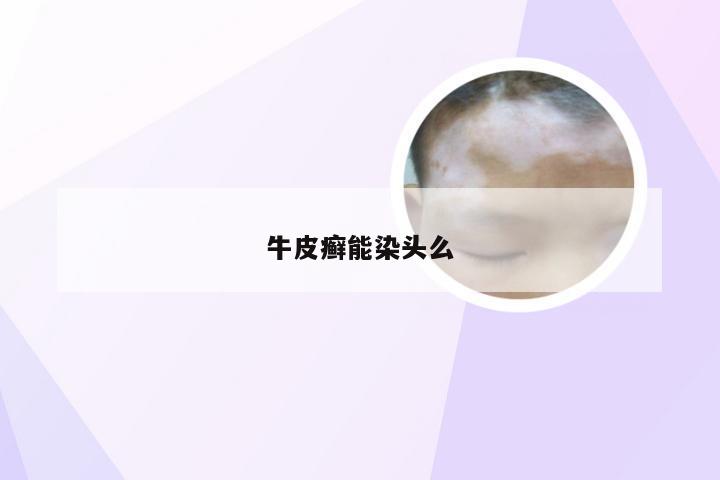 牛皮癣能染头么