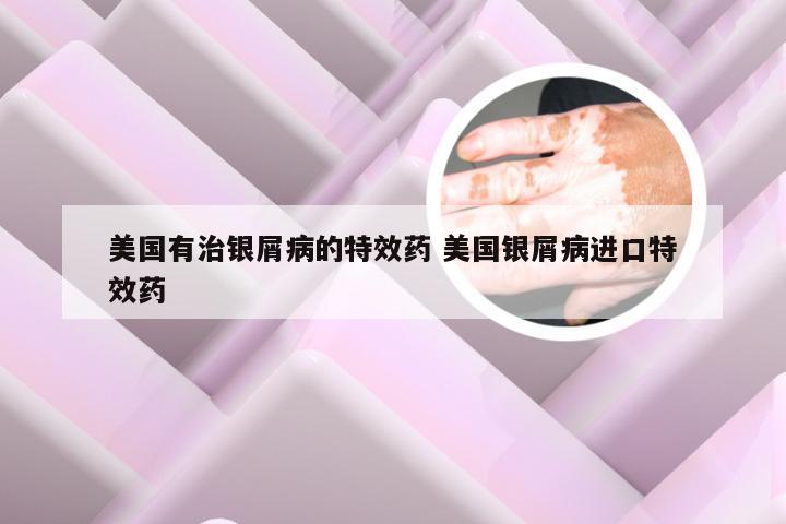 美国有治银屑病的特效药 美国银屑病进口特效药