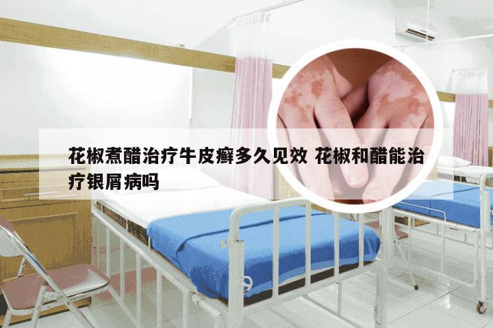 花椒煮醋治疗牛皮癣多久见效 花椒和醋能治疗银屑病吗
