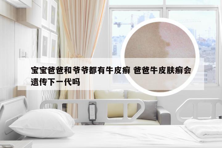 宝宝爸爸和爷爷都有牛皮癣 爸爸牛皮肤癣会遗传下一代吗
