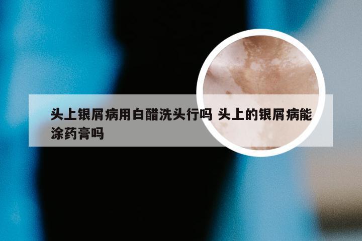 头上银屑病用白醋洗头行吗 头上的银屑病能涂药膏吗
