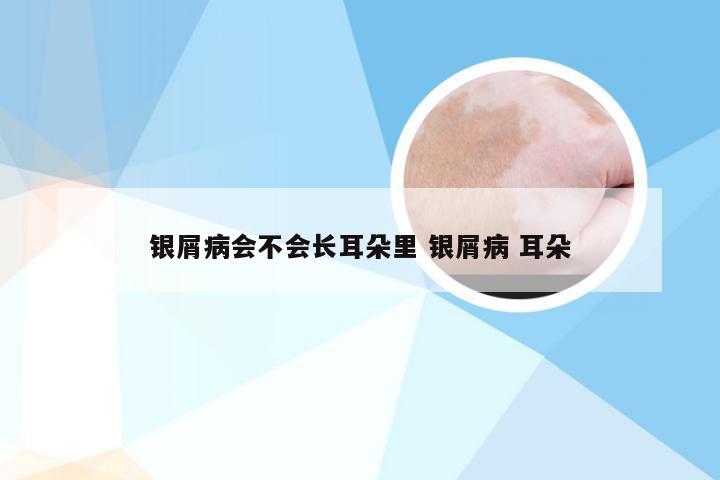 银屑病会不会长耳朵里 银屑病 耳朵