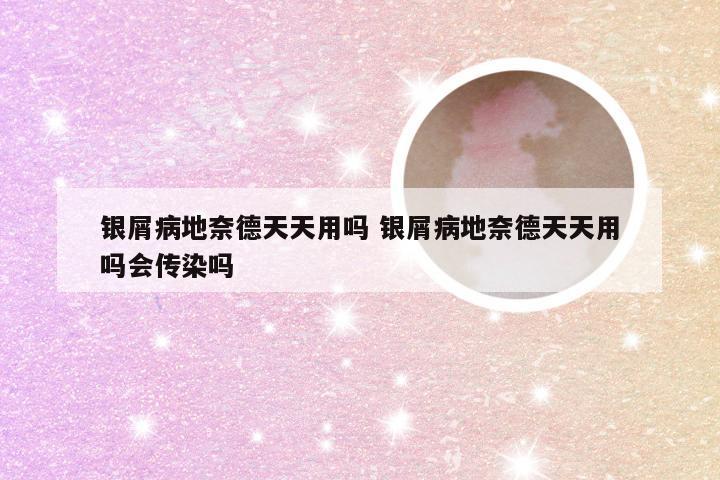 银屑病地奈德天天用吗 银屑病地奈德天天用吗会传染吗