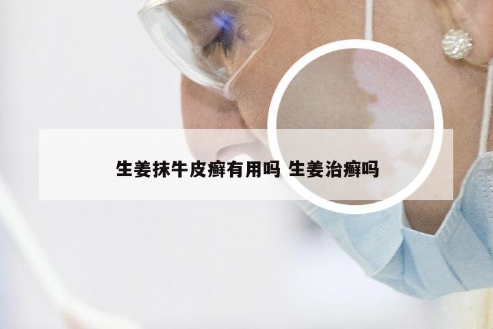 生姜抹牛皮癣有用吗 生姜治癣吗