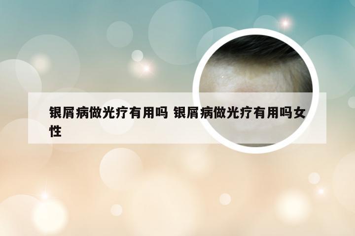 银屑病做光疗有用吗 银屑病做光疗有用吗女性