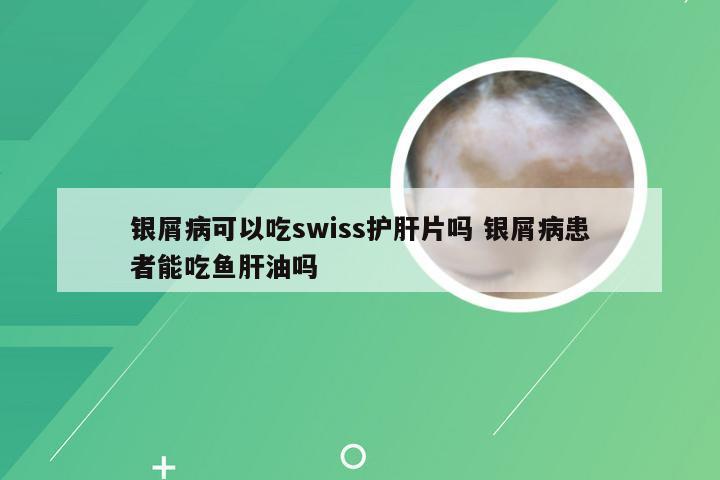 银屑病可以吃swiss护肝片吗 银屑病患者能吃鱼肝油吗