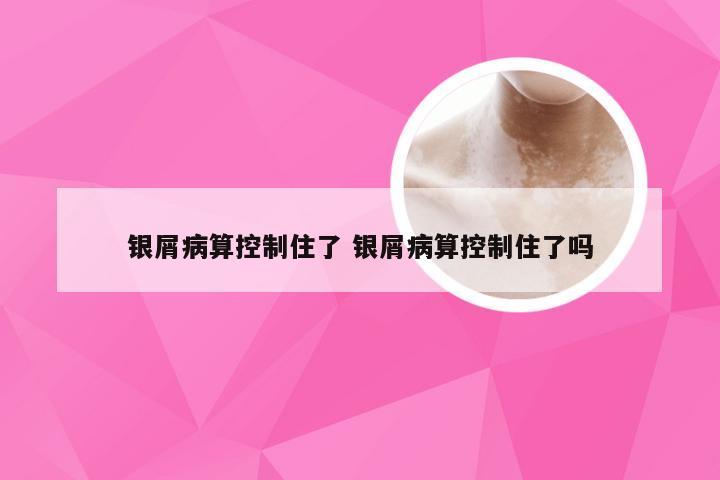银屑病算控制住了 银屑病算控制住了吗