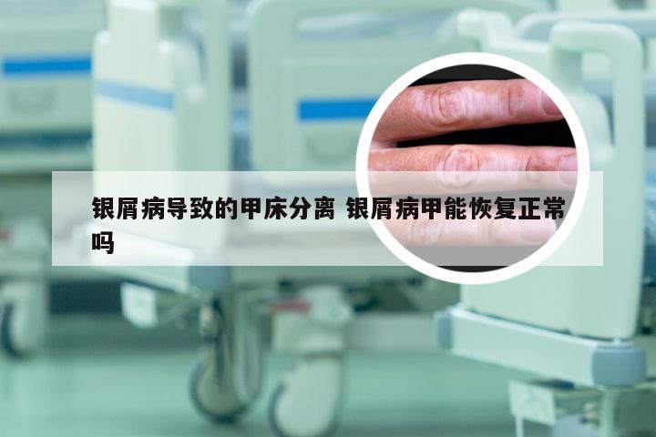 银屑病导致的甲床分离 银屑病甲能恢复正常吗