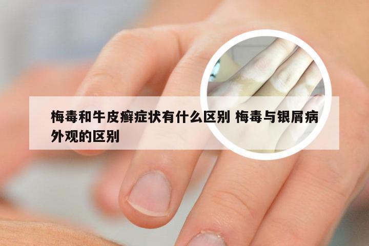梅毒和牛皮癣症状有什么区别 梅毒与银屑病外观的区别